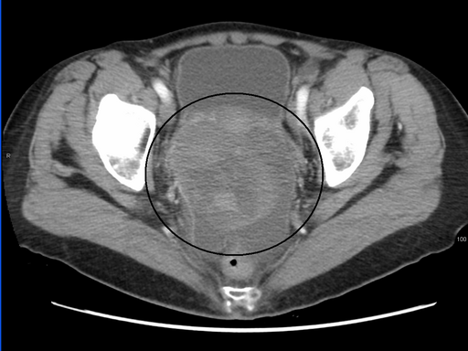 a CT scan showing a large tumour in the ovaries