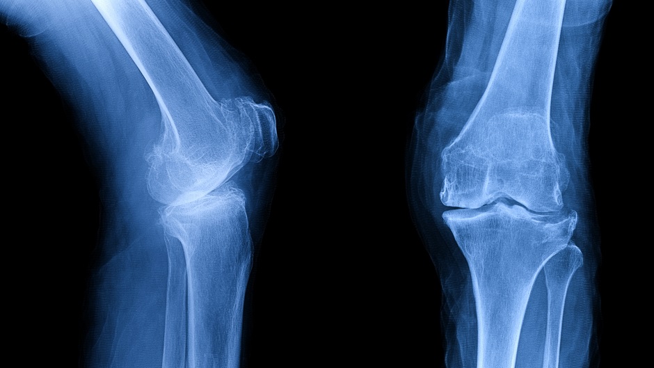 New research could bring relief to those with osteoarthritis